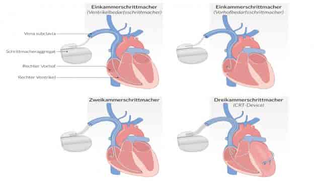 Herzschrittmacher