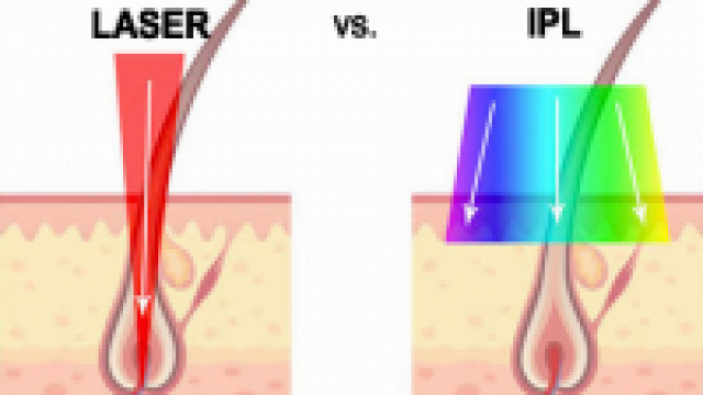 Laser versus IPL Haarentfernung