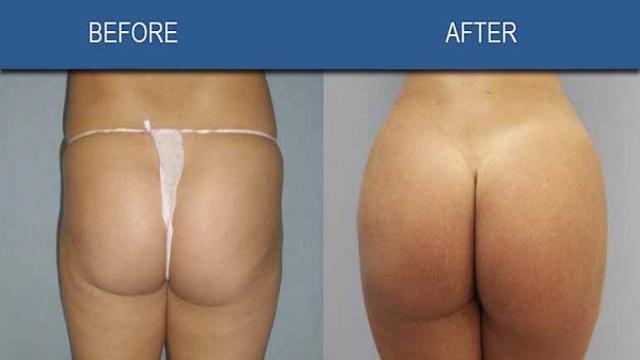 Höchstes Sterberisiko? – Experte erklärt, weshalb der Brazilian Butt Lift so gefährlich ist!