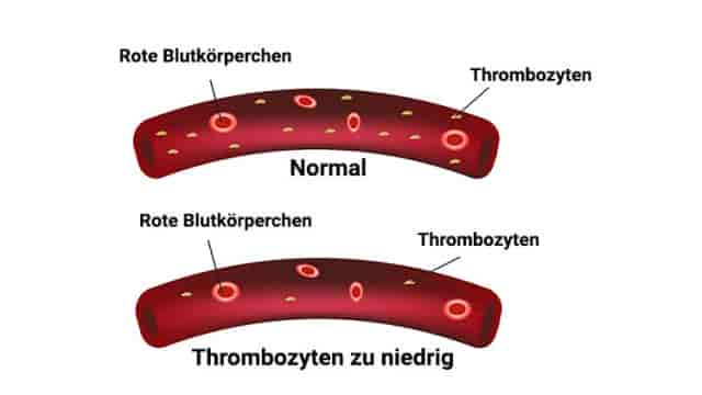 Thrombozytopenie