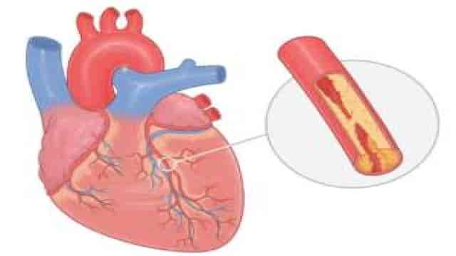 Angina Pectoris