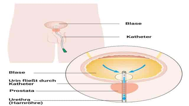 Blasenkatheter