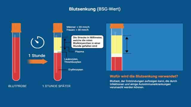 Blutsenkung (BSG-Wert)