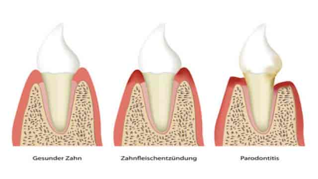 Wie wird eine Parodontitis behandelt?